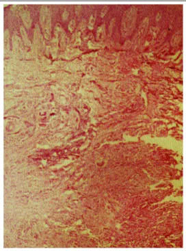 Figura 1: Lesão ulcerada de  bordas infiltradas com fundo