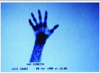 Figura 6: Cintilografia óssea (detalhe da mão direita). Área focal de hiperfixação 