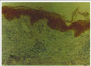Figura 8: Condiloma acuminado. Positividade pan-epidérmica em área de hiperplasia intensa e positividade basal e parabasal em pele perilesional (C14 - 400x) / Figure 8: Condylomata acuminata.