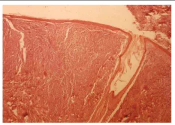 Figura 4: Aspecto histológico da lesão nodular: denso infiltrado na derme superficial e profunda, separado da epiderme por estreita faixa de colágeno (HE, X40)