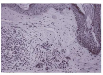 Figure 3: Nevus cells  localized in the epidermis and dermis. Lymphocytary infiltrate involving the  dermal component (HE - 40x)Figura 3: Células névicas