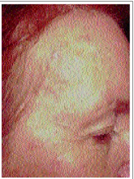 Figura 3: Mesmas lesões da Figura 2  após uma sessão de TFD/ALA.  Controle clínico quatro semanas  após tratamento.