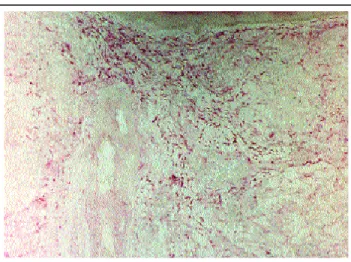 Figure 3: Hyperplasia  of FXIIIa+ dendrocytes in the papillary  dermis and deeper, around the lesion