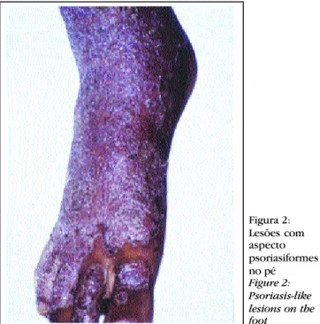 Figura 1: Lesões   eritêmato-escamativas no tronco  Figure 1: Erythematous scaly lesions on the trunk Figura 2: Lesões comaspecto psoriasiformesno péFigure 2:Psoriasis-likelesions on thefoot