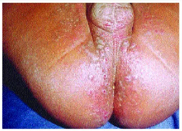 Figura 1: Dermatite de Jacquet. Pápulas  eritematosas associadas com erosões e ulcerações de configuração  crateri-forme na área da fralda.