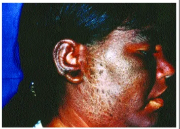 Figura 2: Placas ictiósicas e esclerodermiformes no antebraço direito. / Figure 2: Icteroid and sclerodermatous plaques in right