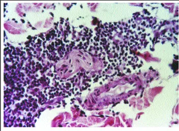 Figure 3: Histological skin sec- sec-tions, stained with  hema-toxylin and eosin (100x), showing dense, inflammatory, perivascular and periadnexal infiltrate, comprising lymphoid cells, with discrete cellular atypia and some mitotic  figures, the majority 