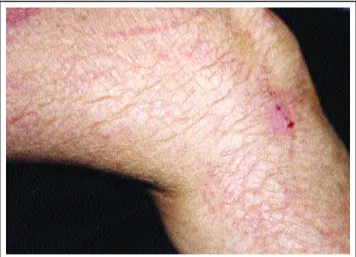 Figura 1: Lesões albopapulóides no antebraço direito.