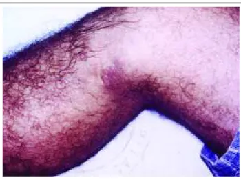 Figure 1: Lesion with a tumor aspect, slightly elevated, with purple-colored zones, 10x5 cm, localized on the medial surface of the right leg, stretching from the knee to the third median.
