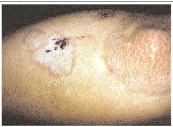 Figu re 1: Lesion s in  the right elbow