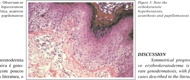 Figu ra 3: Observam-se  hip erceratose  ortoceratótica, acan tose  e p ap ilomatose