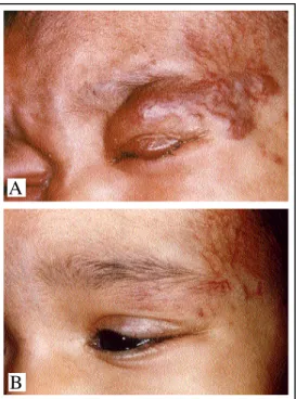 Figure 6A: Corticotherapy  (2 mg/kg/day for four weeks with subsequent reduction of the dose)