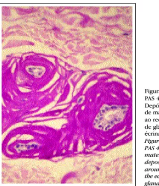 Figura 3: PAS 400X  -Depósito  de material ao redor  de glândula écrina Figure 3: PAS 400X  -material deposited around  the eccrine gland