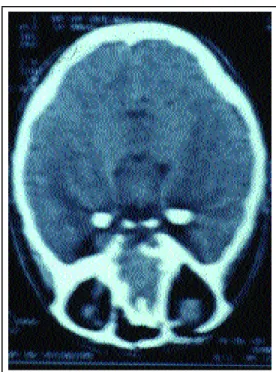 Figure 5: Skull tomogra- tomogra-phy showing bilateral cerebral calcifications in the selar area.