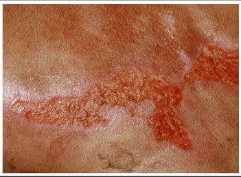 Figure 1 (Case 1): Supra- and infraclavicular regions, on the left, with ulcerated psoriatic plaques, already healing after the onset of treatment.