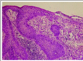 Figura 3 (Caso 2):  Região lombar com placa psoriática ulcerada e sangrante Figure 3 (Case 2): Lumbar region with an ulcerated and  bleeding psoriatic plaque.