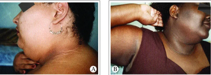 Figura A e B: Aspectos da acanthosis nigricans, afetando pescoço e axila