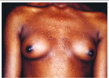 Figure 1: Flat “verruca” (wart-like) lesions with isomorphism on the trunk and upper limbs – benign form