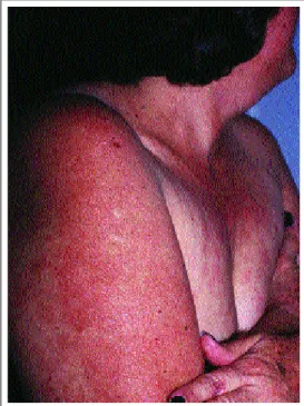 Figura 1: Lesões avermelhadas com hipopigmentação e pequena atrofia no centro. A pele  circundante mostra afinamento e  envelhecimento sugestivos de