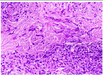 Figura 2: Lesões eritematosas, levemente infiltradas no antebraço. Paciente 2. / Figure 2: Erythematous, slightly infiltrated annular