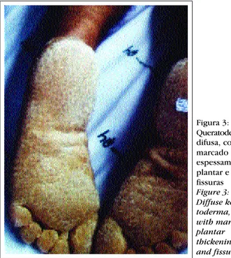 Figure 5: Vacuolar  degeneration of the  gran-ular and spiny layers 