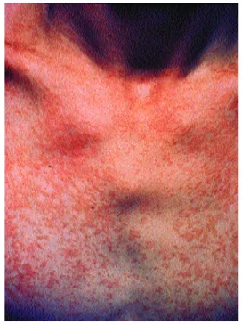 Figure 2: Hyperpigmented lenticular lesions, either isolated or confluent on the trunk.