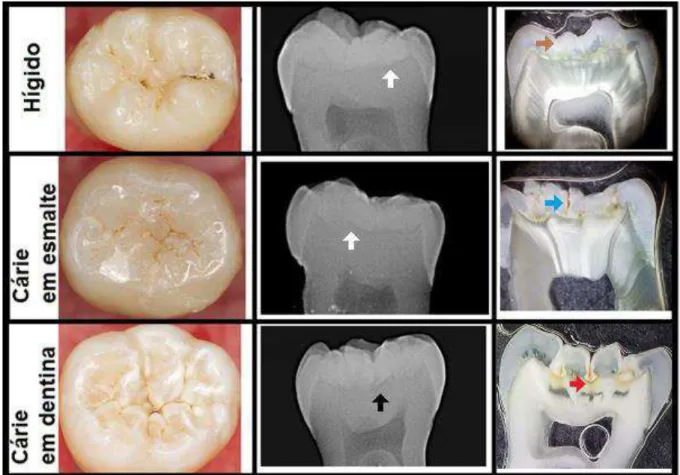 Figura 1 Elementos dentários  utilizados  na pesquisa.  Imagem  clínica,  imagem  radiográfica e imagem em lupa estereoscópica