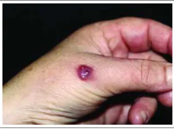 Figura 1: Lesão nodular  violácea com  superfície brilhante.
