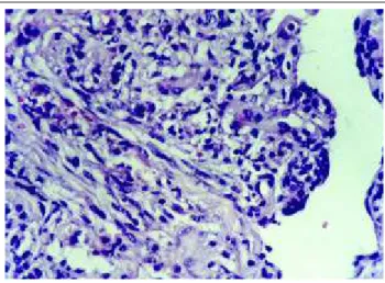 Figure 2: Endothelial  proliferation of  spindle-shaped and oblong cells with a 