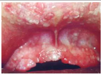 Figure 1: Multiple papules in the gingivae, and upper and lower lips. Aspect similar to small &#34;round pebbles.&#34;Figura 1: Múltiplas pápulas nas