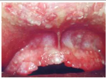 Figure 1: Multiple papules in the gingivae, and upper and lower lips. Aspect similar to small "round pebbles."Figura 1: Múltiplas pápulas nas