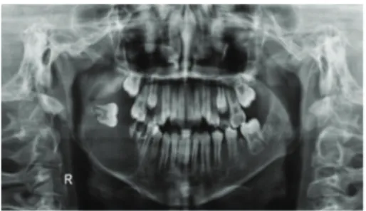Figure 2: Panoramic radiograph: radiolucid image of right mandibular body and ramus, with involvement of the included tooth