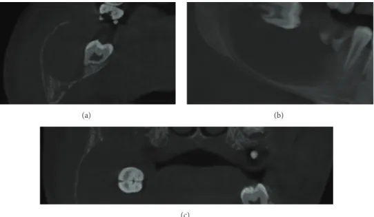 Figure 3: CBCT images showing axial (a), sagittal (b), and coronal (c) slices demonstrating the expansive aspect of the lesion and its internal homogeneous appearance.