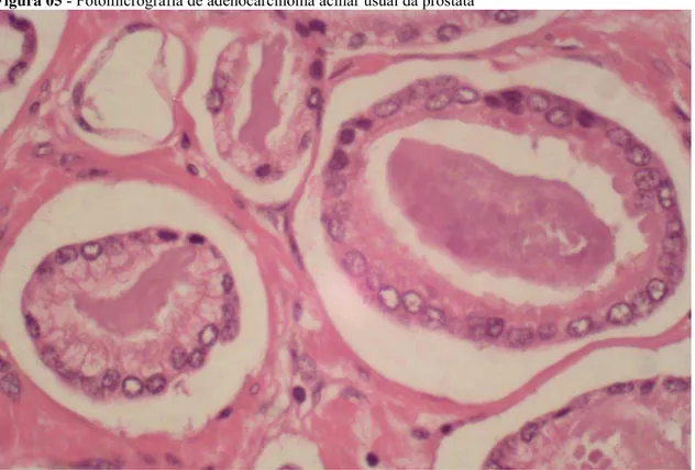 Figura 05 - Fotomicrografia de adenocarcinoma acinar usual da próstata 