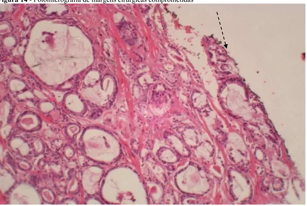 Figura 14 - Fotomicrografia de margens cirúrgicas comprometidas 