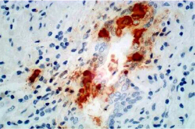 Figura 16 - Fotomicrografia de diferenciação neuroendócrina no epitélio não neoplásico