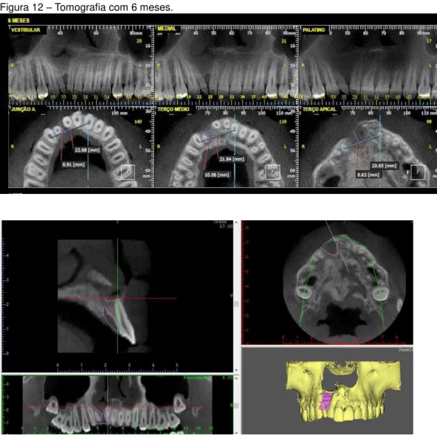 Figura 12  –  Tomografia com 6 meses. 