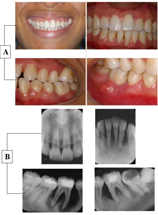 ILUSTRAÇÃO 2. Aspectos clínico (A) e radiográfico (B) de paciente com periodontite  agressiva