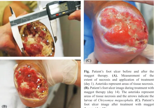 Fig.  Patient’s  foot  ulcer  before  and  after  the  maggot  therapy.  (A).   Measurement  of  the  extent  of  necrosis  and  application  of  treatment   (day 1)