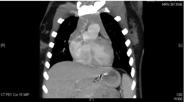 FIG 1. Pre-operative CT chest coronal view 