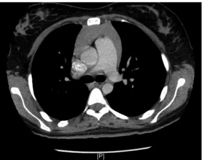 FIG 4. Post-operative CT chest axial view 