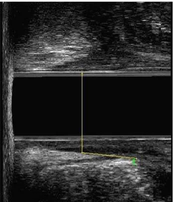 Figura 3 - Escaneamento em repouso - plano LM – Ângulo no repouso, formado por um linha medindo  1,5cm paralela a face interna do PR que tangencia uma linha perpendicular ao eixo do canal anal