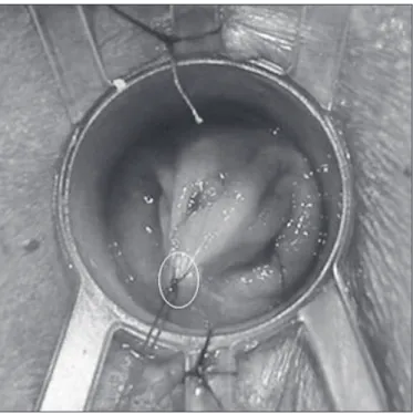 FIGURE  1.  The  apex  of  the  rectocele  is  identiied  and  pulled  down  through a stitch (circle)