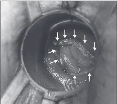 FIGURE 4.  The remaining stapled suture line (arrows)