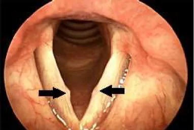 Figura 2.5: Imagem videolaringoscópica mostrando a presença de nódulos nas pregas vocais, indicados pelas setas ( SULICA , 2009).