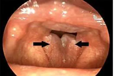 Figura 2.8: Imagem videolaringoscópica mostrando as pregas vocais com edema de Reinke grave e que pode causar dificuldade para respirar