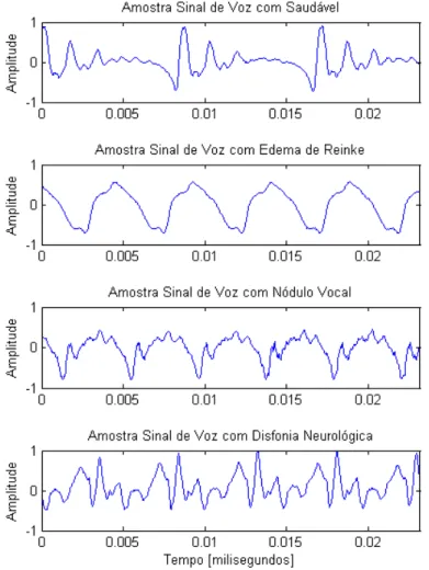 Figura 5.1: Exemplos de sinais de voz para vogais sustentadas /a/.