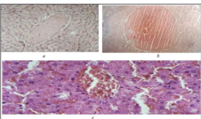 FIGURA 1 - Estudo histológico, por microscopia ótica, dos fígados de animais do grupo 1 (a  e  b) e grupo 2 (c), nos quais se diagnosticaram: trombose da veia hepática (a); trombose lobular com necrose associada (b); estase  centro-lobular associada à dila