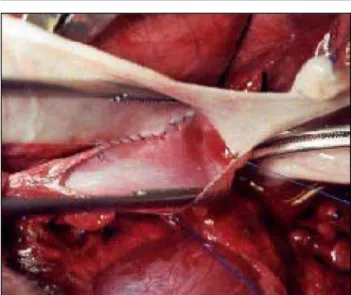 FIGURA 1 - Retalho de submucosa sendo suturado na veia