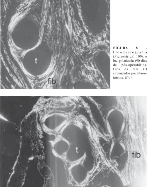 FIGURA 9 - Fotomicrografia (Picrossírius) 100x e luz polarizada (90 dias de pós-operatório)